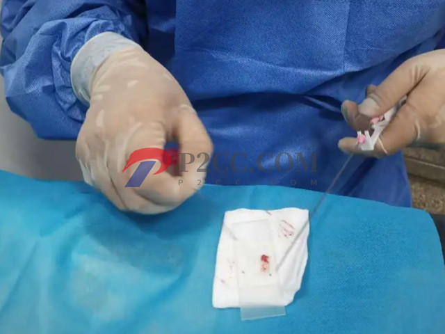 睾丸穿刺手术费用清单,术前检查+手术费不超过这个数(图2) 睾丸穿刺是经过皮肤对睾丸进行穿刺