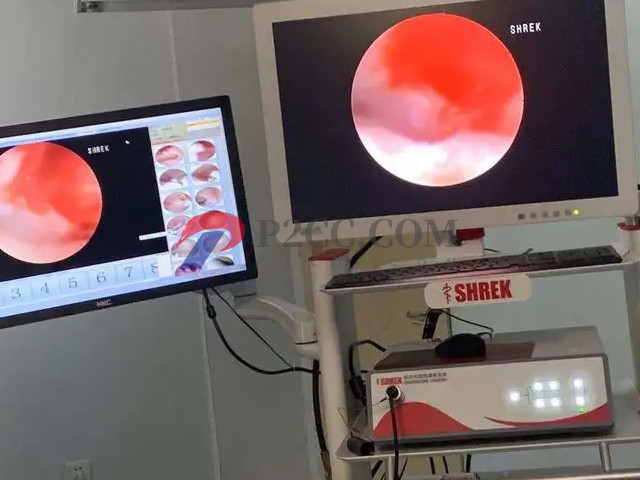 试管移植前这4类人群必做宫腔镜,能大大提升成功率(图1) 宫腔镜手术能提升试管成功率