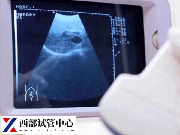 羊水穿刺很可怕?做羊穿的好处、风险、最佳时间、适应人群速览(图1) 羊水穿刺适合哪些人做