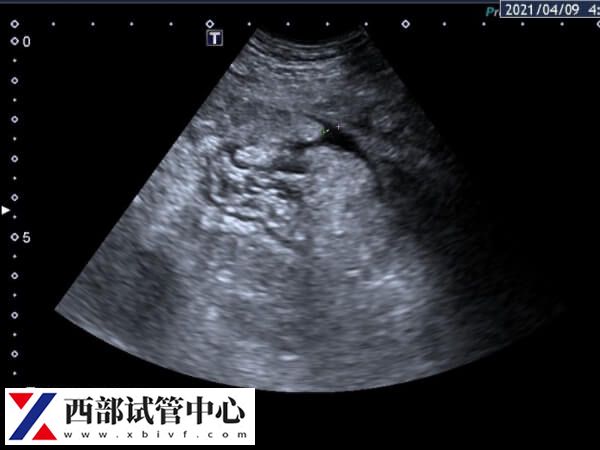 取卵第2天肚子胀还能不能移植鲜胚(图1) 取卵后肚子胀大概率是腹水