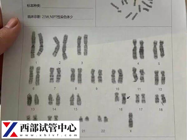 二代试管不可以避免染色体异常(图1) 二代试管不可以筛查染色体