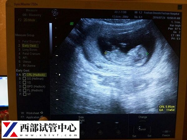 试管婴儿要不要天天做b超(图1) 试管婴儿进周期前要做b超检查