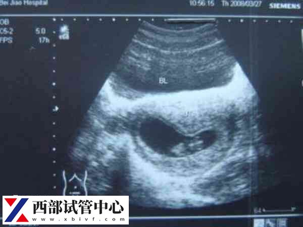 试管移植成功后多久做b超(图1) 试管移植后要按时做b超