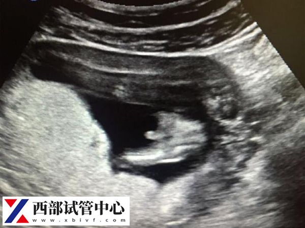 二次B超是移植后的6-7周实施