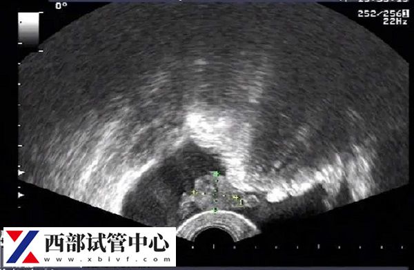 囊胚移植一超没有卵黄囊二超可能会有